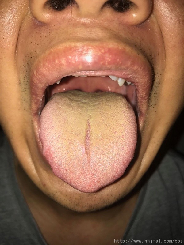 案例1－＞3、再服3剂［大柴胡汤］之后，脸发热及心慌改善，舌体明显变小，舌苔变得黄.jpg