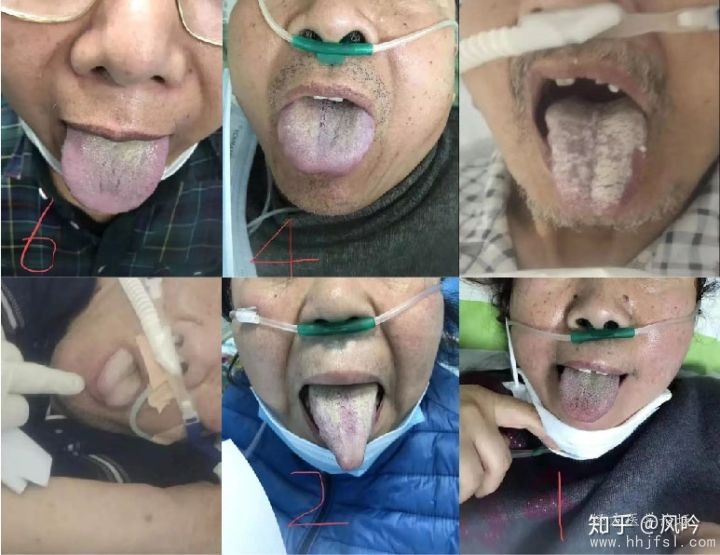从这六位新冠肺炎患者的舌象看（肺疫初期三阳病主要表现在舌苔，判断体质要看舌体舌质.jpg