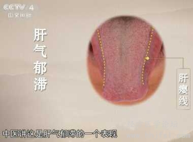 肝气郁结的舌象：肝缨线《中华医药》观舌知病.jpg
