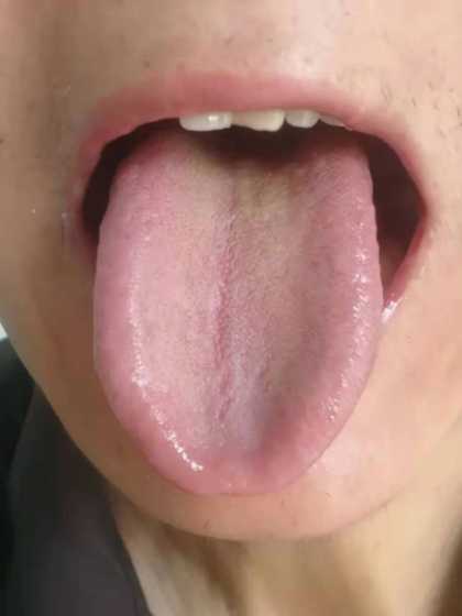 舌诊