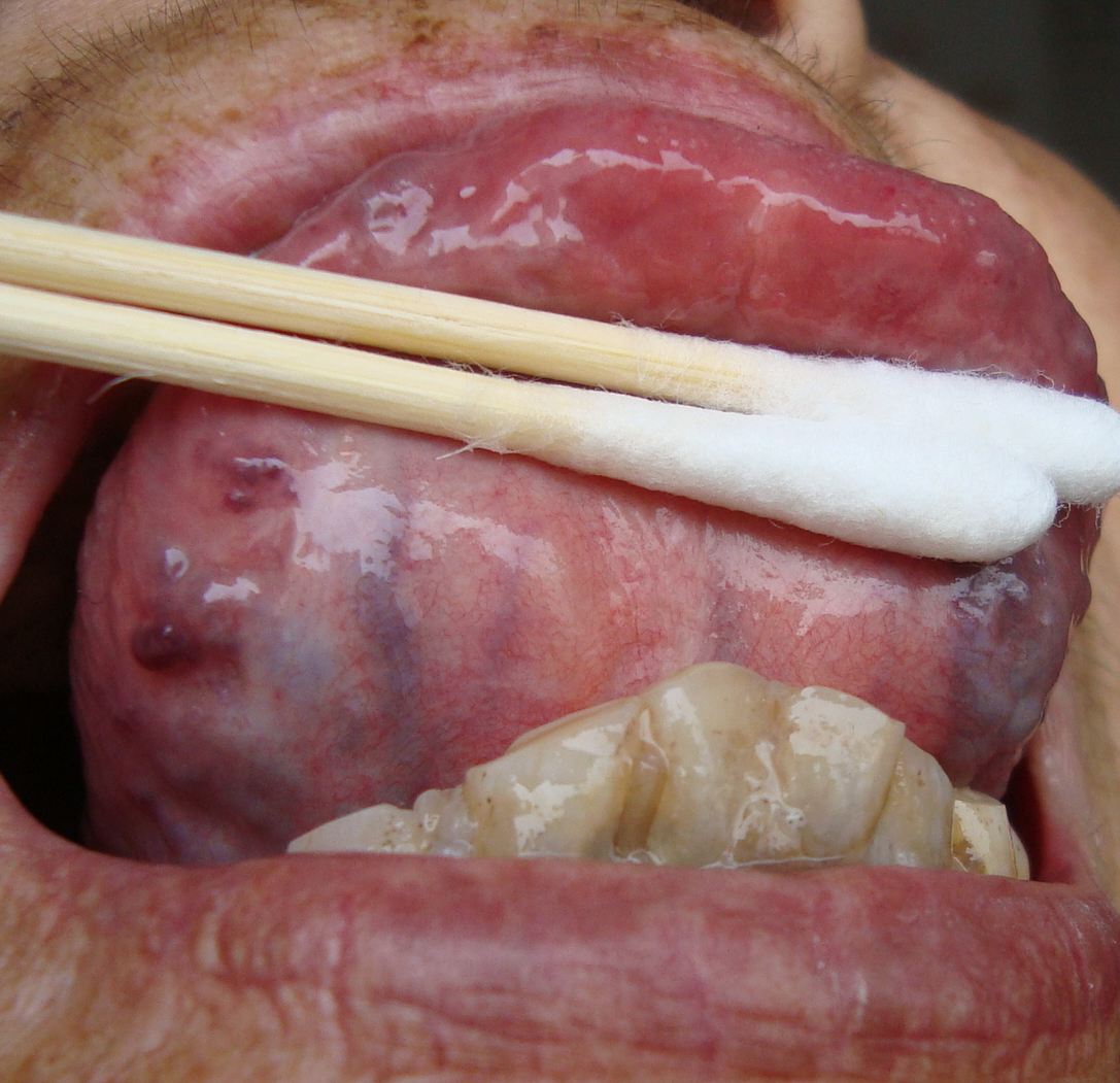 第一诊舌下脉络