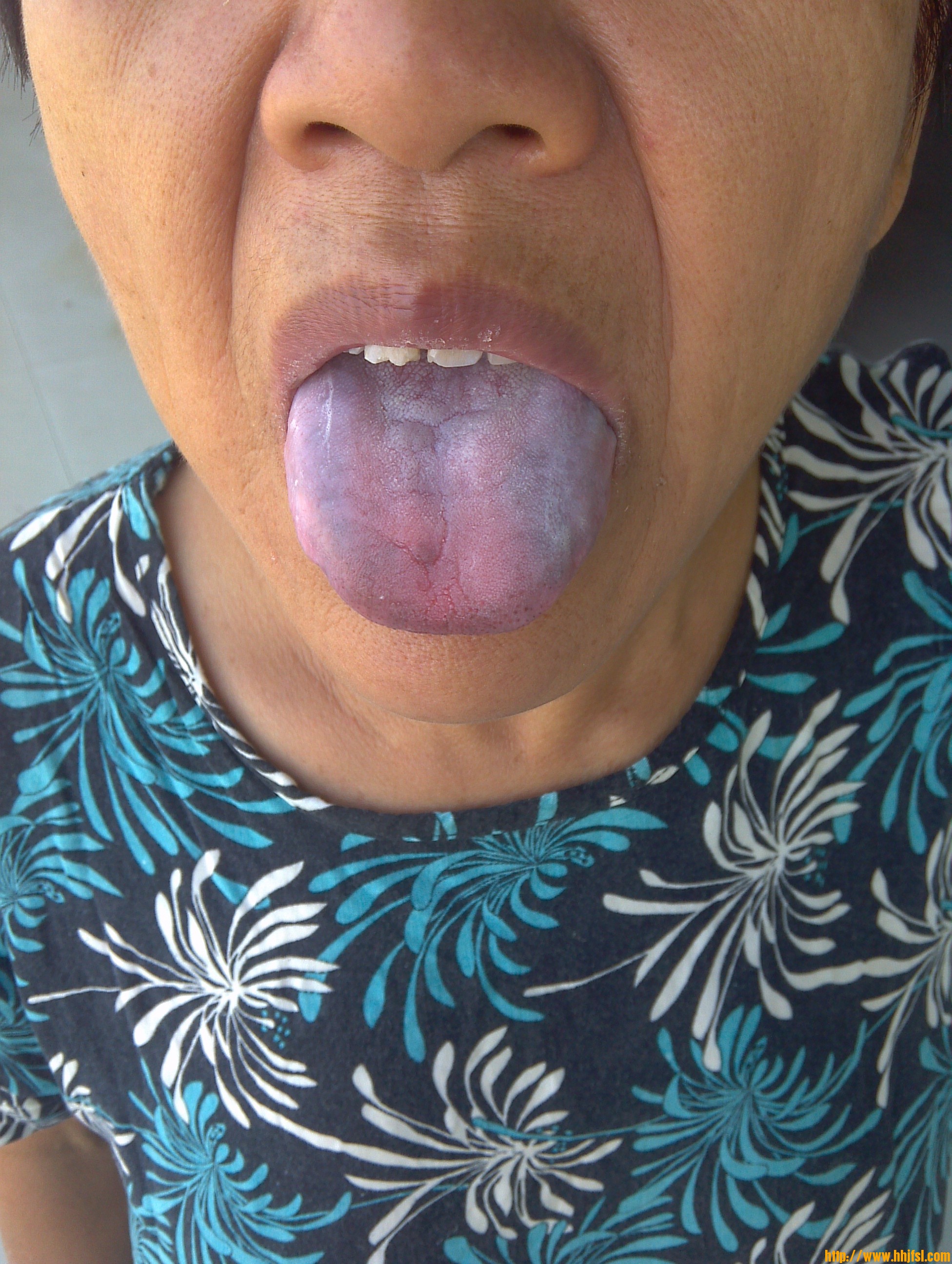 淤血舌