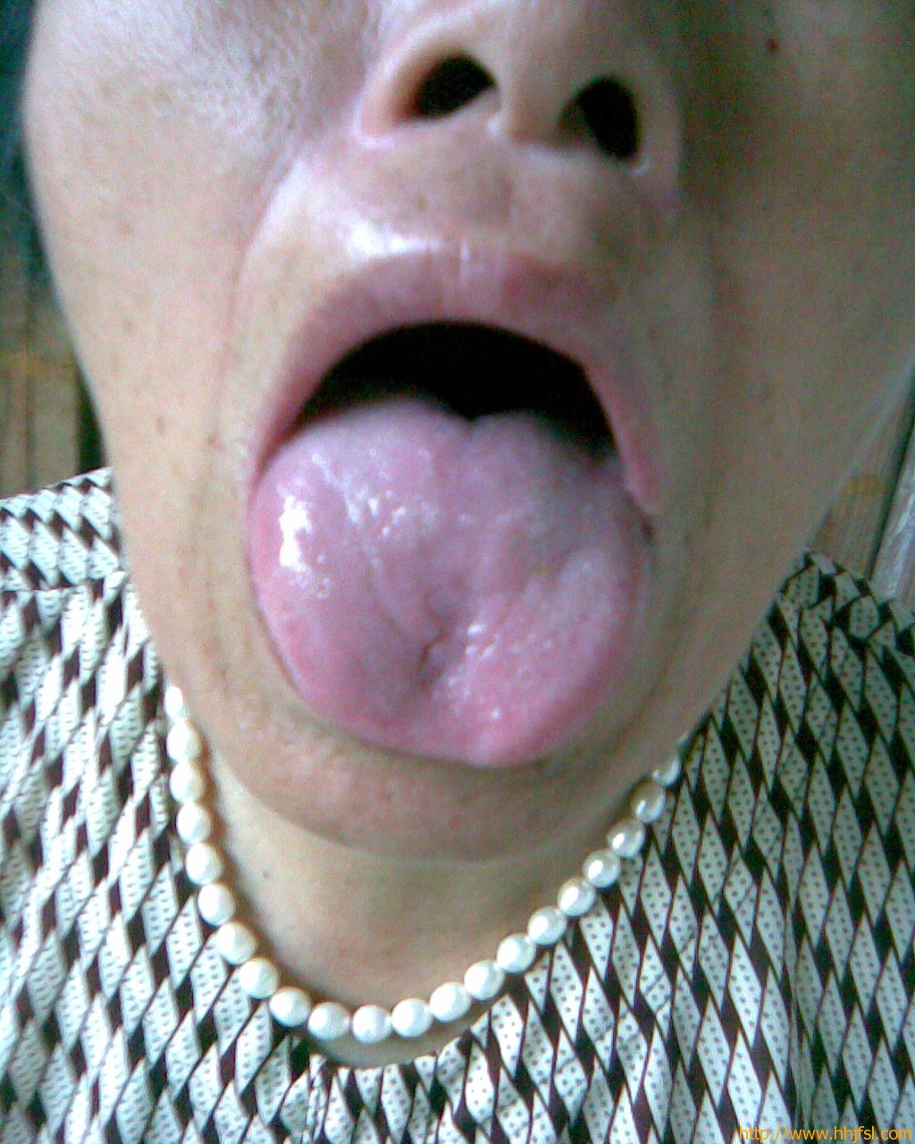 患者舌象